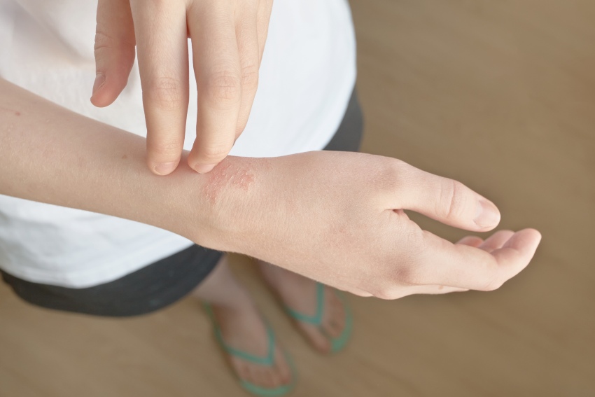 A close-up of a wrist showing a small rash illustrating healing eczema & psoriasis in San Diego, CA