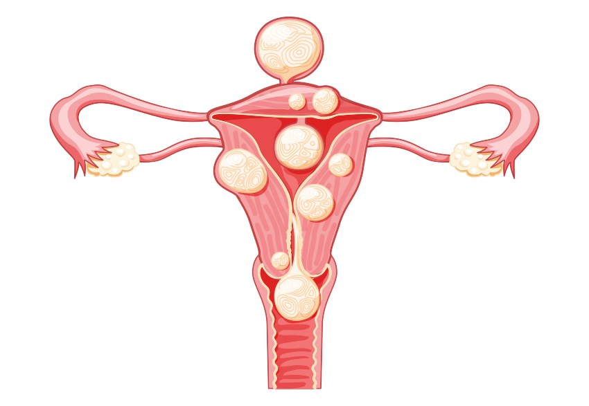 Image highlighting area affected by fibroids with a focus on miscarriage prevention in San Diego, CA
